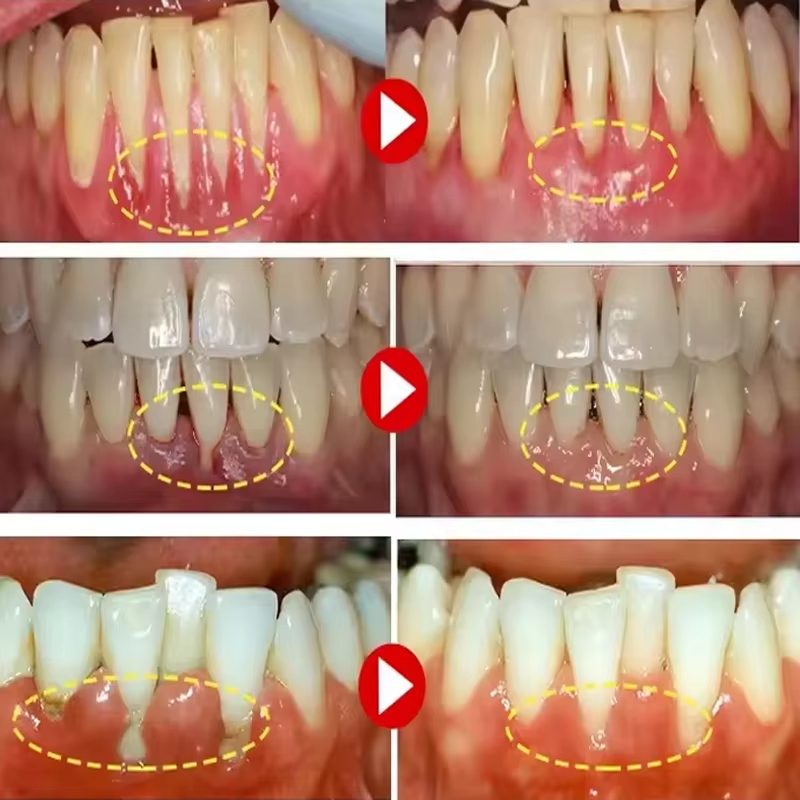 Teeth Whitening Gel Gum Repair - Teeth Whitening Gel review and price