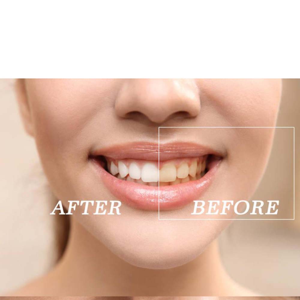 Top Quality Peroxide Teeth Whi - Teeth Whitening Gel review and price